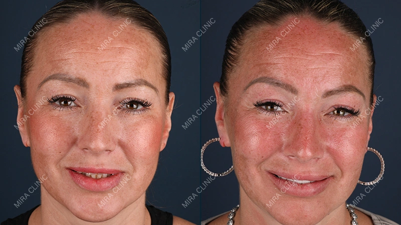 Hollywood Smile Patients